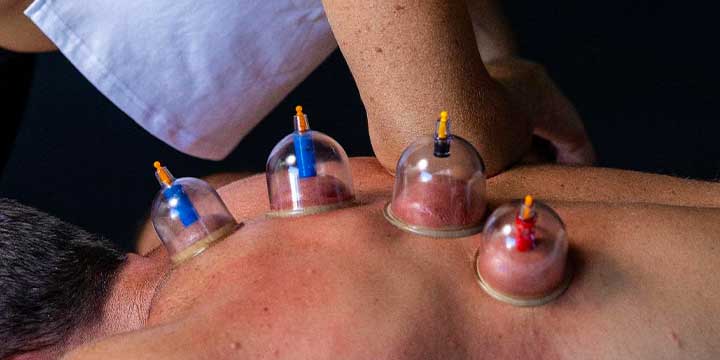 Cupping